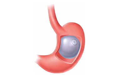 Técnica Banda Gástrica