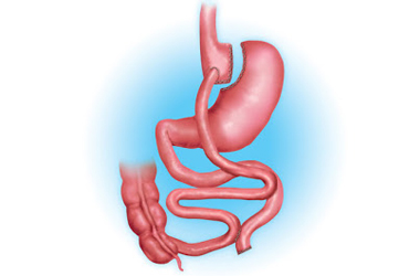 Técnica Bypass Gástrico