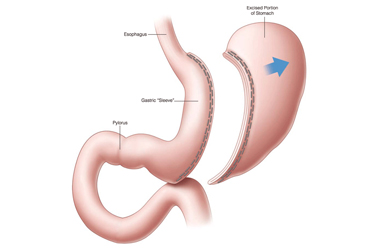 Técnica Banda Gástrica